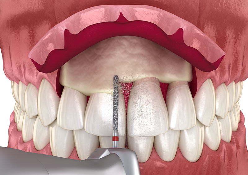 crown lengthening