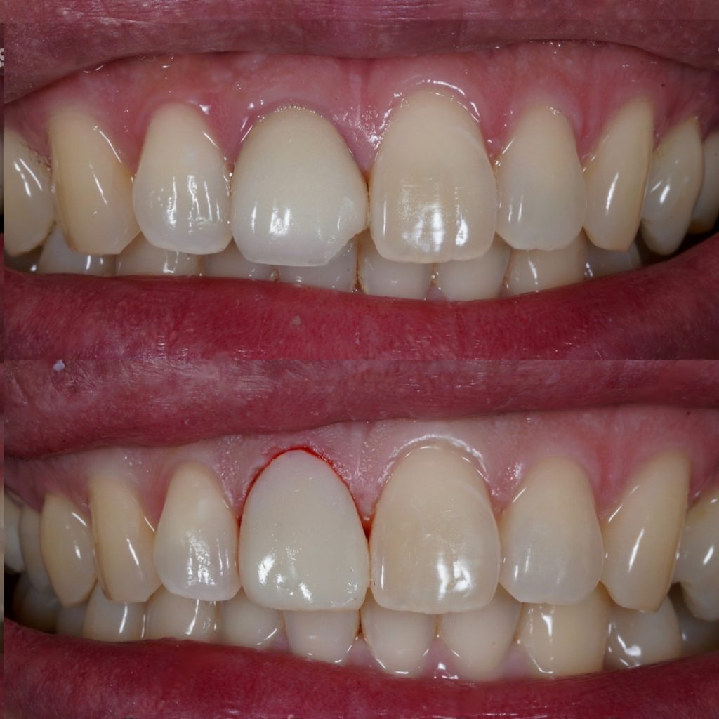 gingivectomy