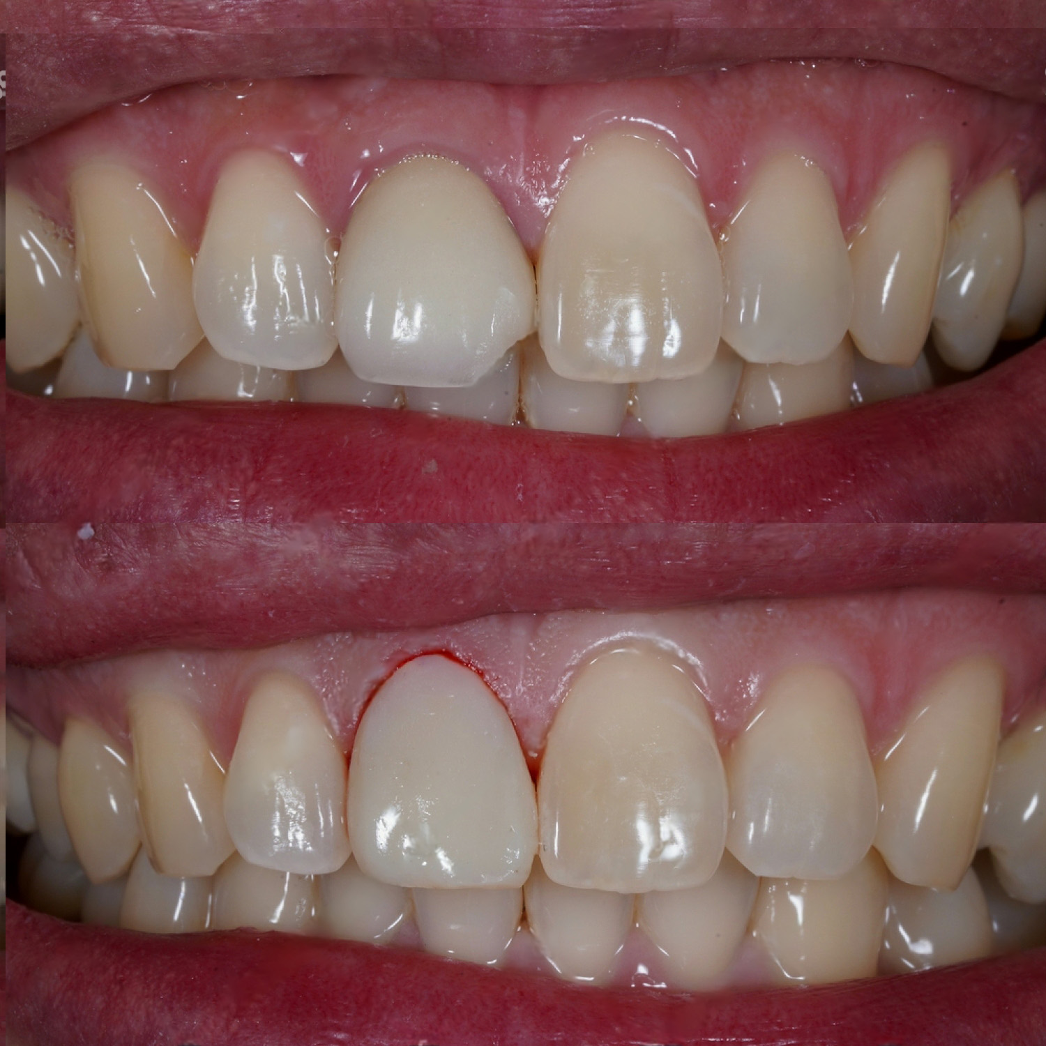 gingivectomy
