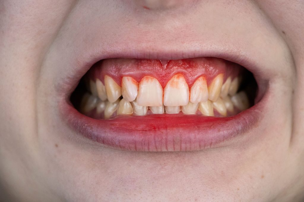 periodontitis reversal